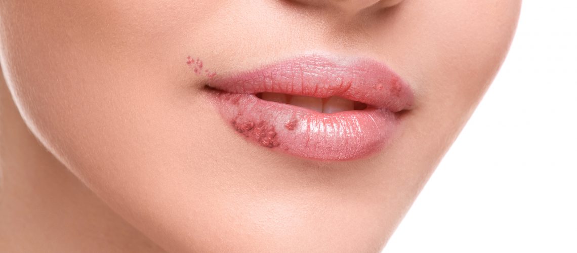 Close up of female lips affected by herpes virus